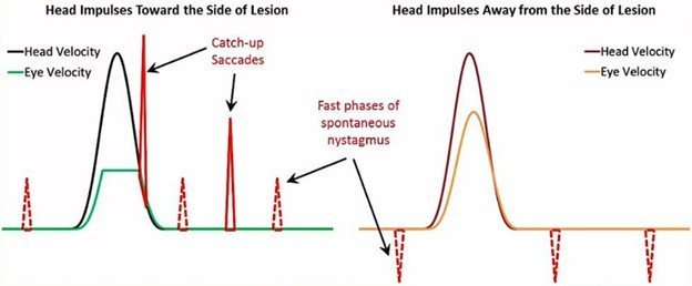 The Video Head Impulse Test